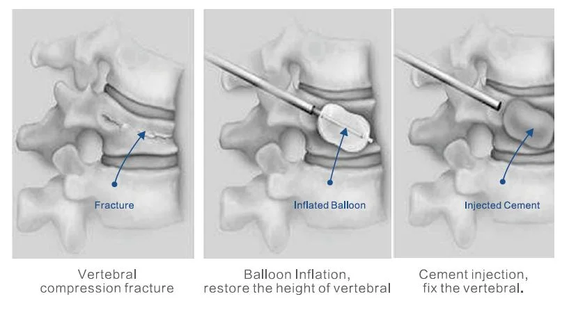 Kyphoplasty Systems Surgical Bone Cement Balloon Catheter Applier Vetebral Body Puncture Needle